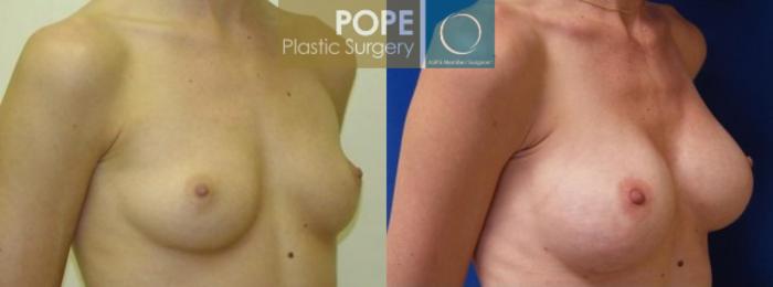 Before & After Breast Augmentation Case 126 View #2 View in Orlando, FL