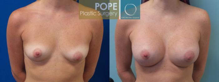 Before & After Breast Augmentation Case 127 View #1 View in Orlando, FL