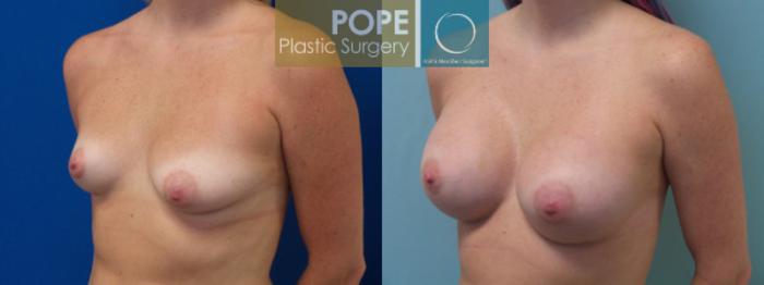 Before & After Breast Augmentation Case 127 View #2 View in Orlando, FL