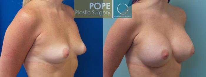 Before & After Breast Augmentation Case 127 View #3 View in Orlando, FL