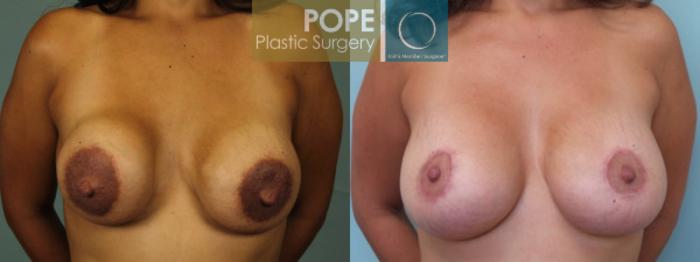Before & After Breast Augmentation Case 129 View #1 View in Orlando, FL