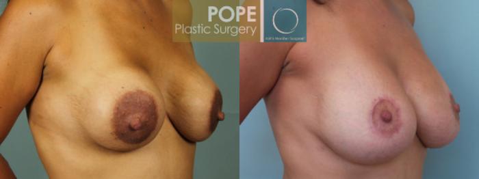 Before & After Breast Augmentation Case 129 View #2 View in Orlando, FL