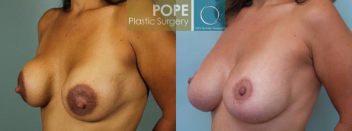 Before & After Breast Augmentation Case 129 View #3 View in Orlando, FL