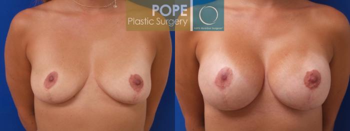 35-year-old patient, bilateral breast augmentation with gel implants