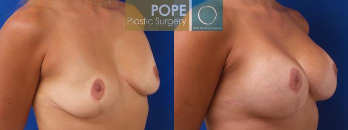 Age 35, breast augmentation with gel implants