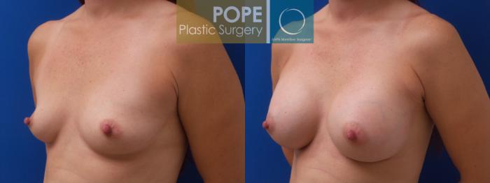 Before & After Breast Augmentation Case 191 Left Side View in Orlando, FL
