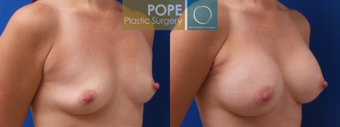 Before & After Breast Augmentation Case 191 Right Side View in Orlando, FL