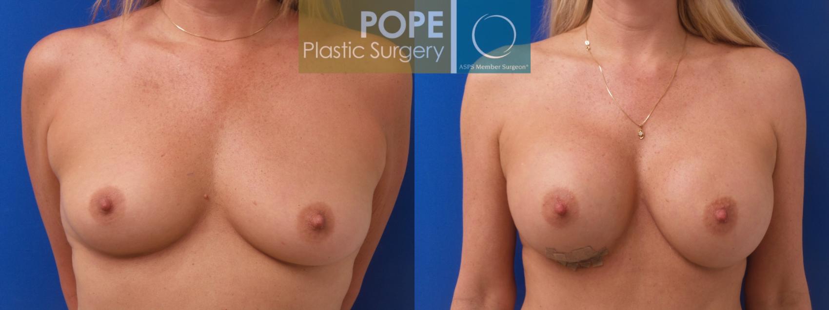 Before & After Breast Lift Case 193 Front View in Orlando, FL