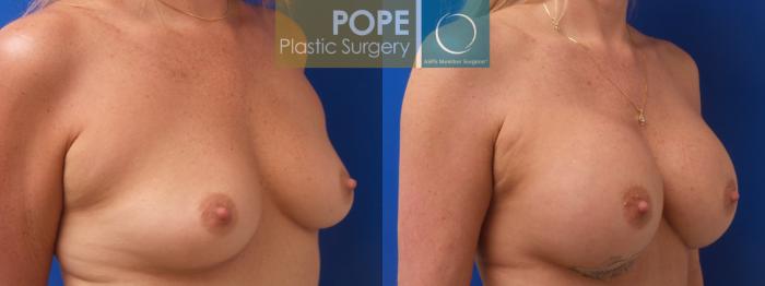 Before & After Breast Augmentation Case 193 Left Oblique View in Orlando, FL
