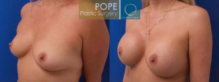 Before & After Breast Augmentation Case 193 Right Oblique View in Orlando, FL