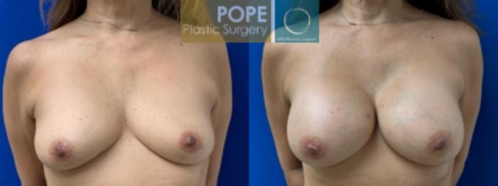 53-year-old woman with mild breast asymmetry. Silicone gel implants. Right 285cc, Left 305cc