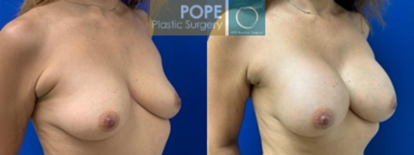 53-year-old woman with mild breast asymmetry. Silicone gel implants. Right 285cc, Left 305cc