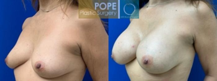 53-year-old woman with mild breast asymmetry. Silicone gel implants. Right 285cc, Left 305cc