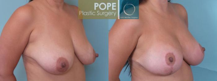 Before & After Breast Augmentation Case 34 View #2 View in Orlando, FL