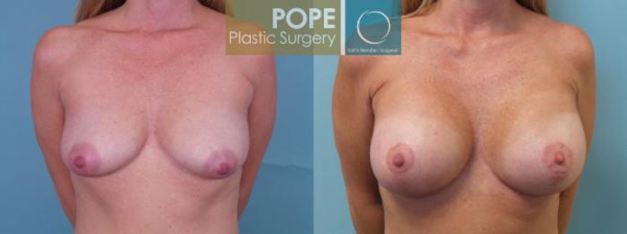 Before & After Breast Augmentation Case 35 View #1 View in Orlando, FL