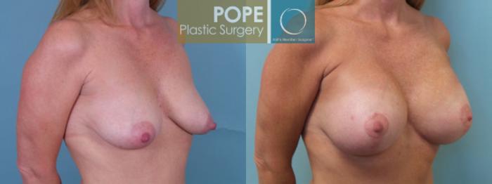 Before & After Breast Augmentation Case 35 View #2 View in Orlando, FL