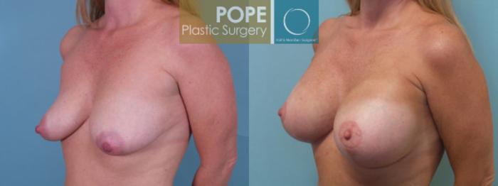 Before & After Breast Augmentation Case 35 View #3 View in Orlando, FL