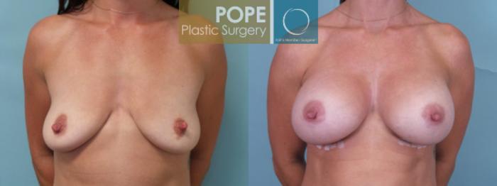 Before & After Breast Augmentation Case 36 View #1 View in Orlando, FL