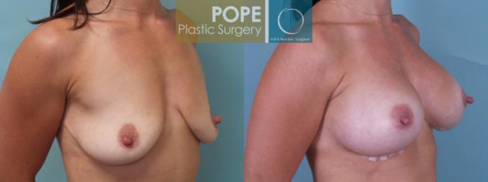 Before & After Breast Augmentation Case 36 View #2 View in Orlando, FL