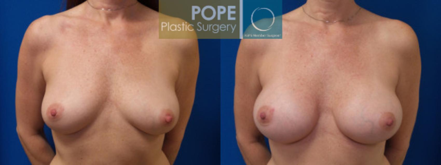 Before & After Breast Augmentation Case 37 View #1 View in Orlando, FL
