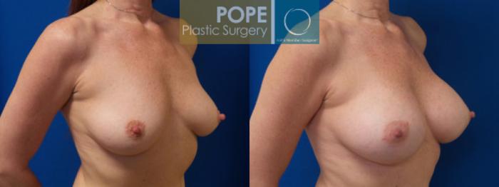 Before & After Breast Augmentation Case 37 View #2 View in Orlando, FL