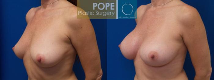 Before & After Breast Augmentation Case 37 View #3 View in Orlando, FL