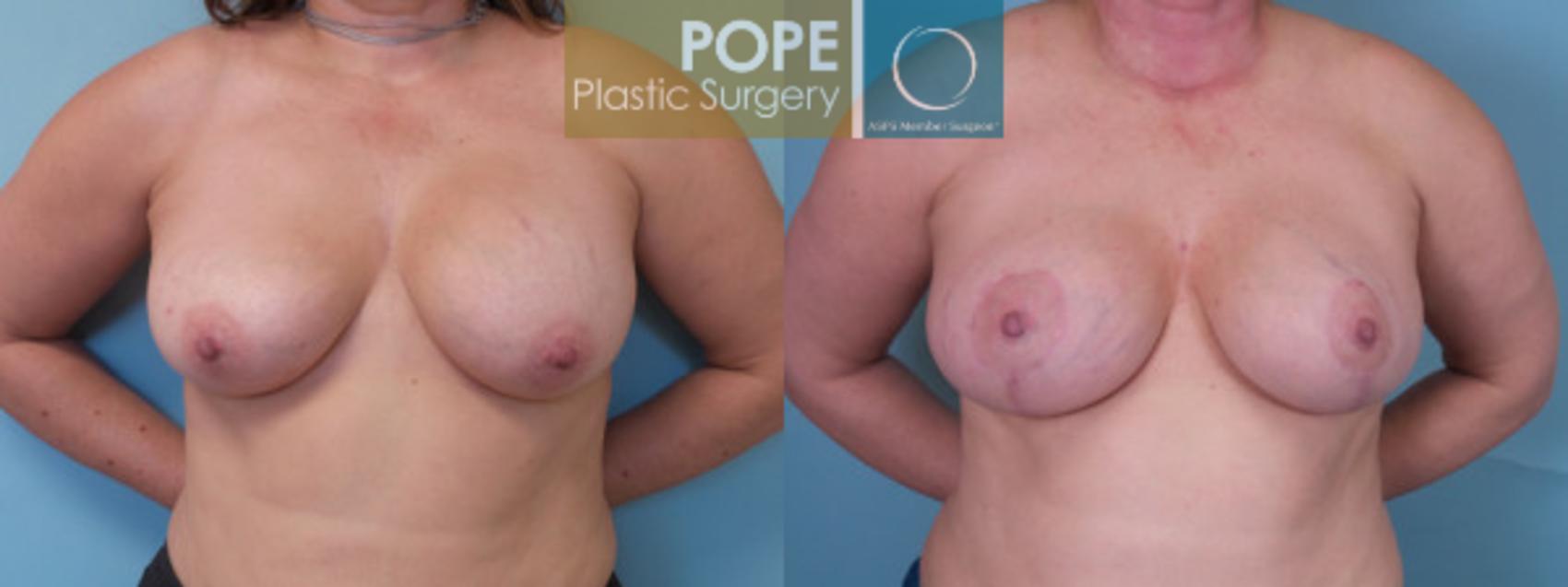 Before & After Breast Augmentation Case 38 View #1 View in Orlando, FL