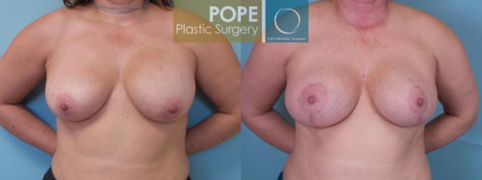 Before & After Breast Augmentation Case 38 View #1 View in Orlando, FL