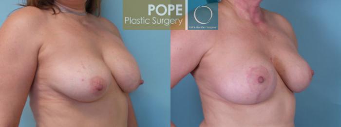 Before & After Breast Augmentation Case 38 View #2 View in Orlando, FL