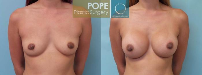 Before & After Breast Augmentation Case 80 View #1 View in Orlando, FL