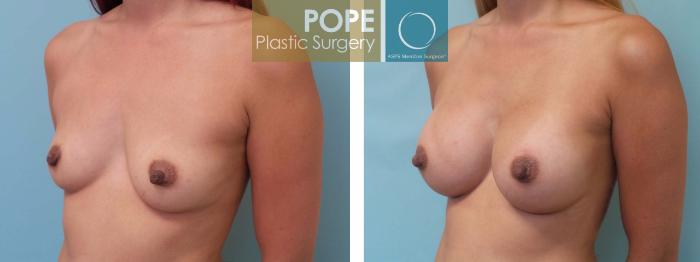 Before & After Breast Augmentation Case 80 View #2 View in Orlando, FL
