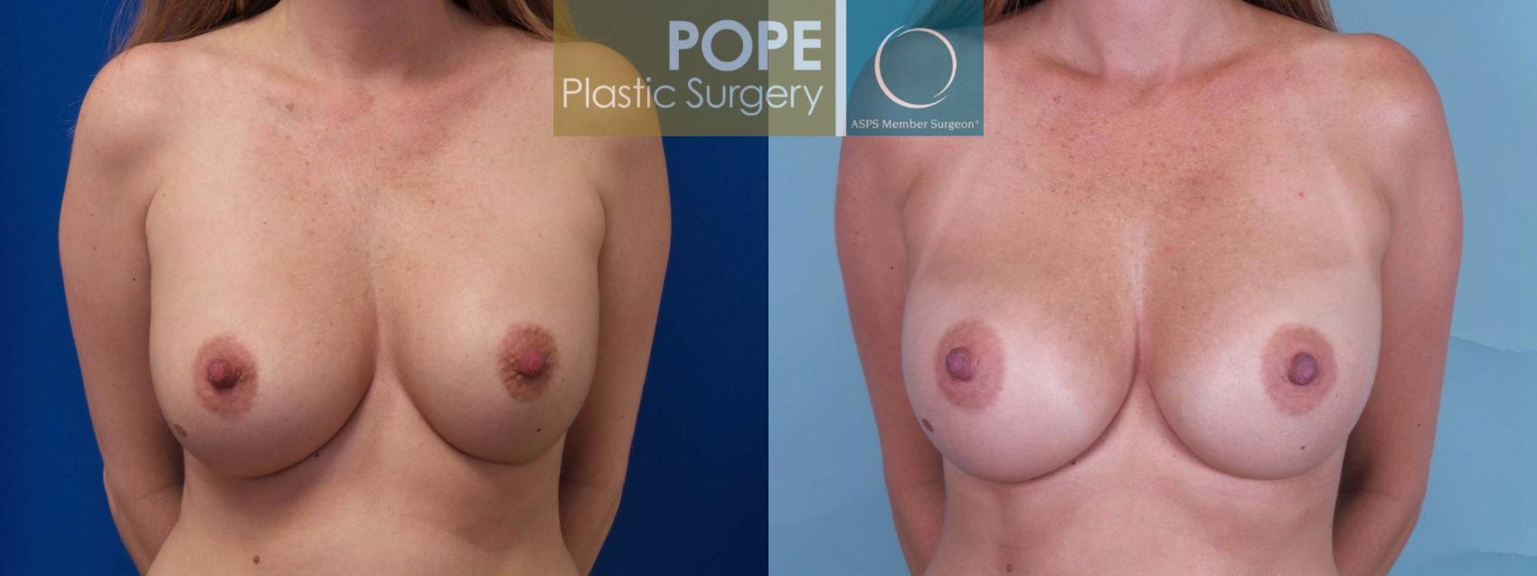 Before & After Breast Augmentation Case 81 View #1 View in Orlando, FL