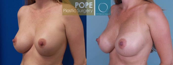 Before & After Breast Augmentation Case 81 View #2 View in Orlando, FL