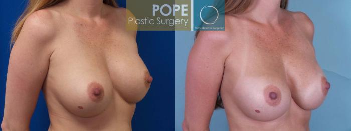 Before & After Breast Augmentation Case 81 View #3 View in Orlando, FL