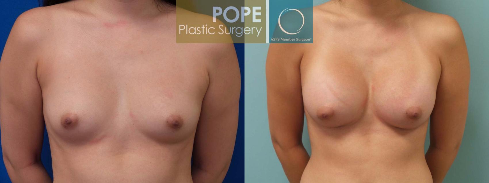 Before & After Breast Augmentation Case 82 View #1 View in Orlando, FL
