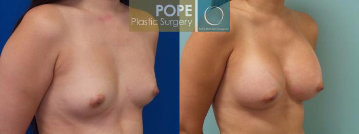 Before & After Breast Augmentation Case 82 View #2 View in Orlando, FL