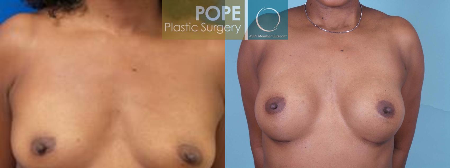 Before & After Breast Augmentation Case 83 View #1 View in Orlando, FL