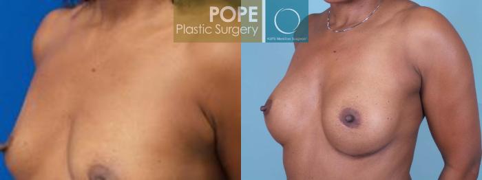 Before & After Breast Augmentation Case 83 View #2 View in Orlando, FL