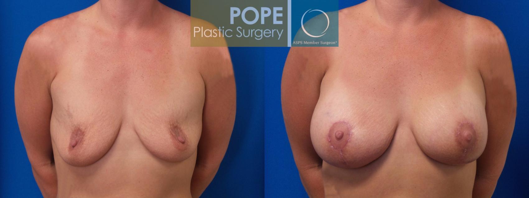 Before & After Breast Augmentation Case 84 View #1 View in Orlando, FL