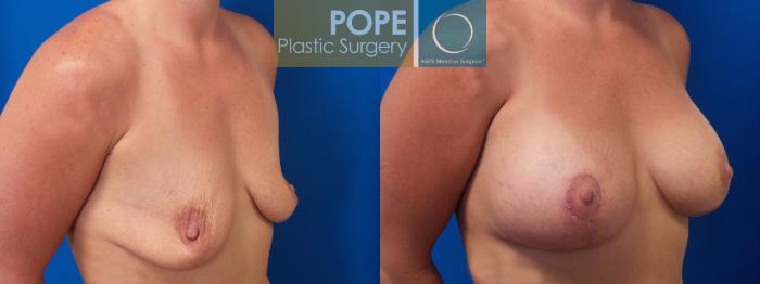 Before & After Breast Augmentation Case 84 View #2 View in Orlando, FL