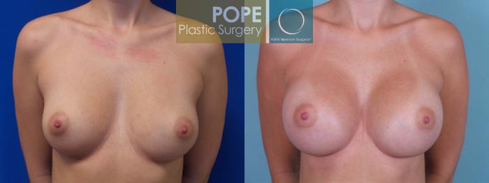 Before & After Breast Augmentation Case 85 View #1 View in Orlando, FL