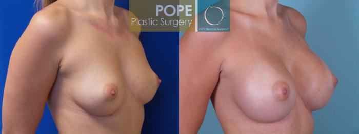 Before & After Breast Augmentation Case 85 View #2 View in Orlando, FL