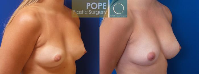 Before & After Breast Augmentation Case 87 View #2 View in Orlando, FL