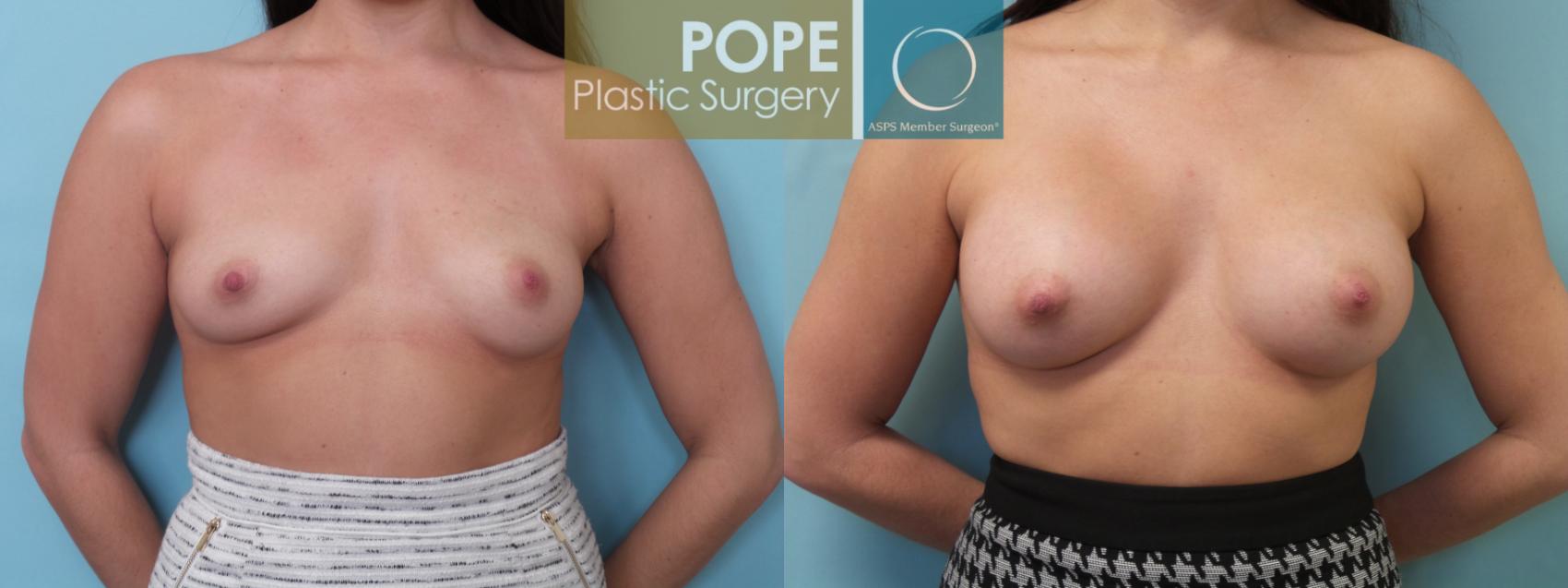 Before & After Breast Augmentation Case 89 View #1 View in Orlando, FL