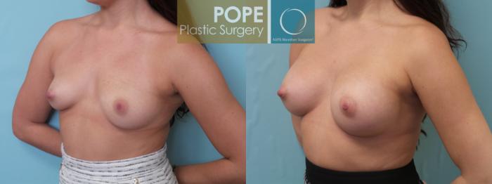 Before & After Breast Augmentation Case 89 View #2 View in Orlando, FL