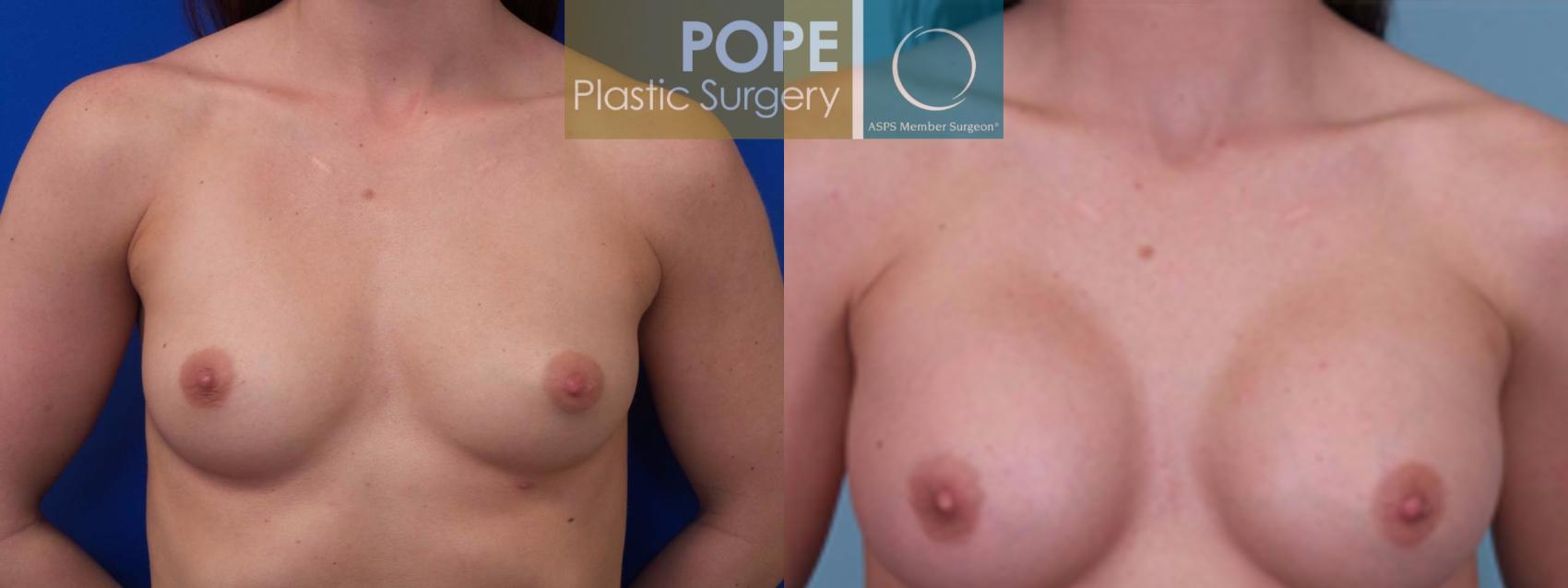 Before & After Breast Augmentation Case 90 View #1 View in Orlando, FL