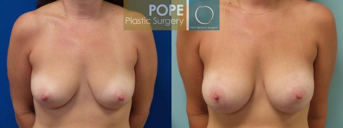 Before & After Breast Augmentation Case 91 View #1 View in Orlando, FL