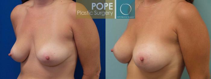 Before & After Breast Augmentation Case 91 View #2 View in Orlando, FL