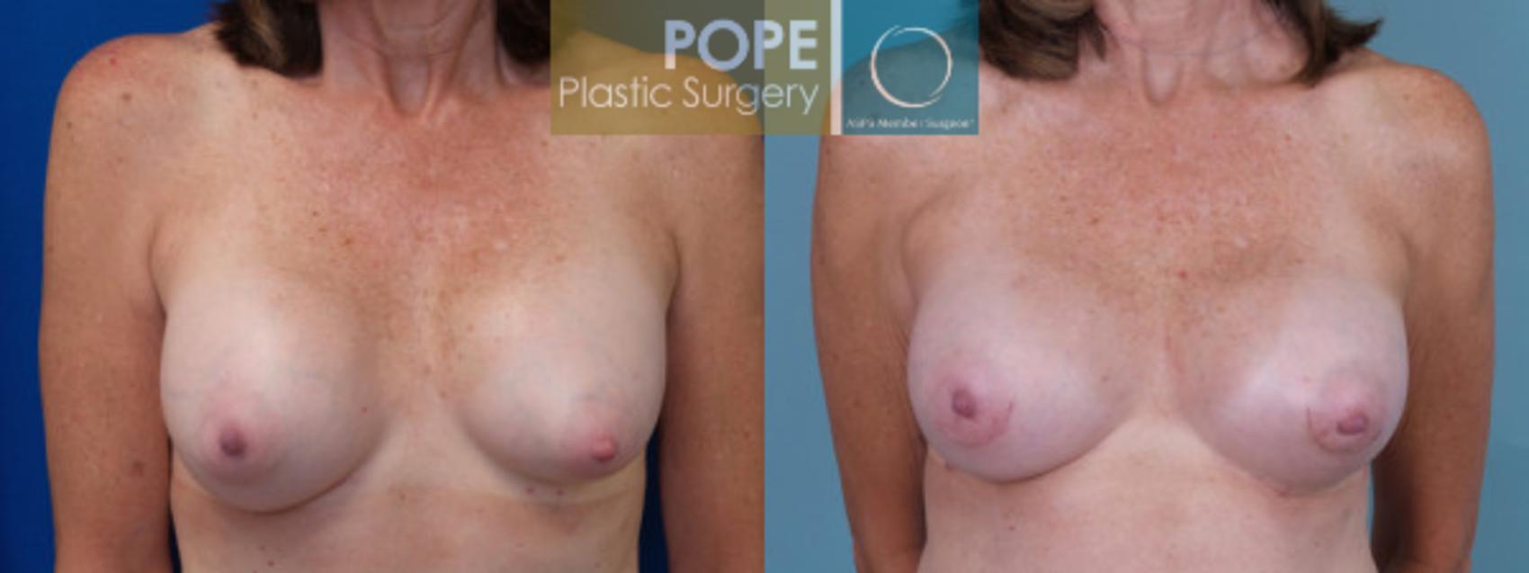 Before & After Breast Capsulectomy Case 128 View #1 View in Orlando, FL