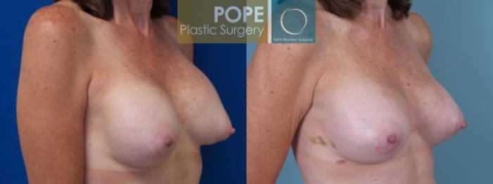 Before & After Breast Capsulectomy Case 128 View #2 View in Orlando, FL
